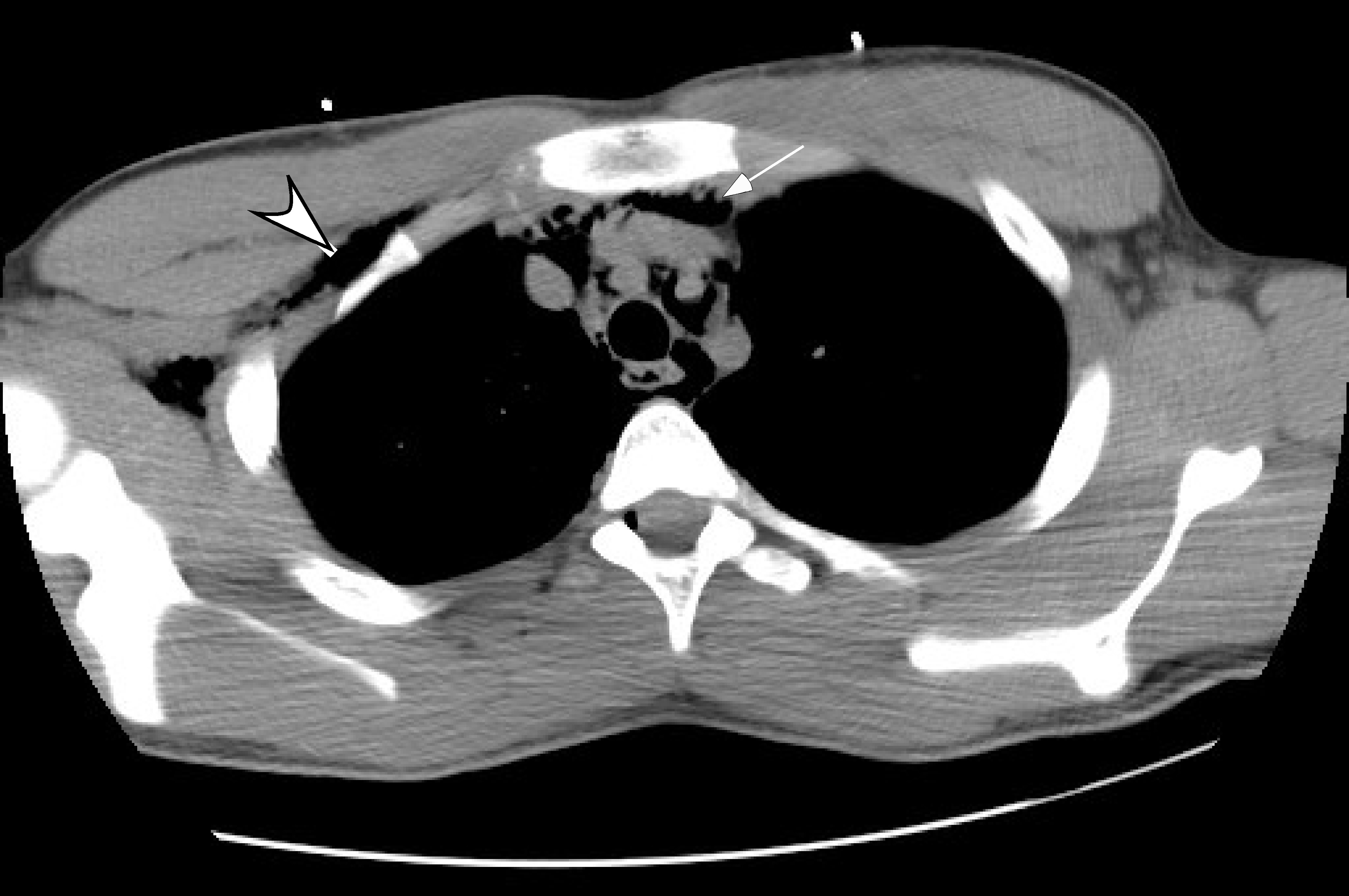 Subcutaneous Emphysema And Pneumomediastinum On Compu Vrogue Co