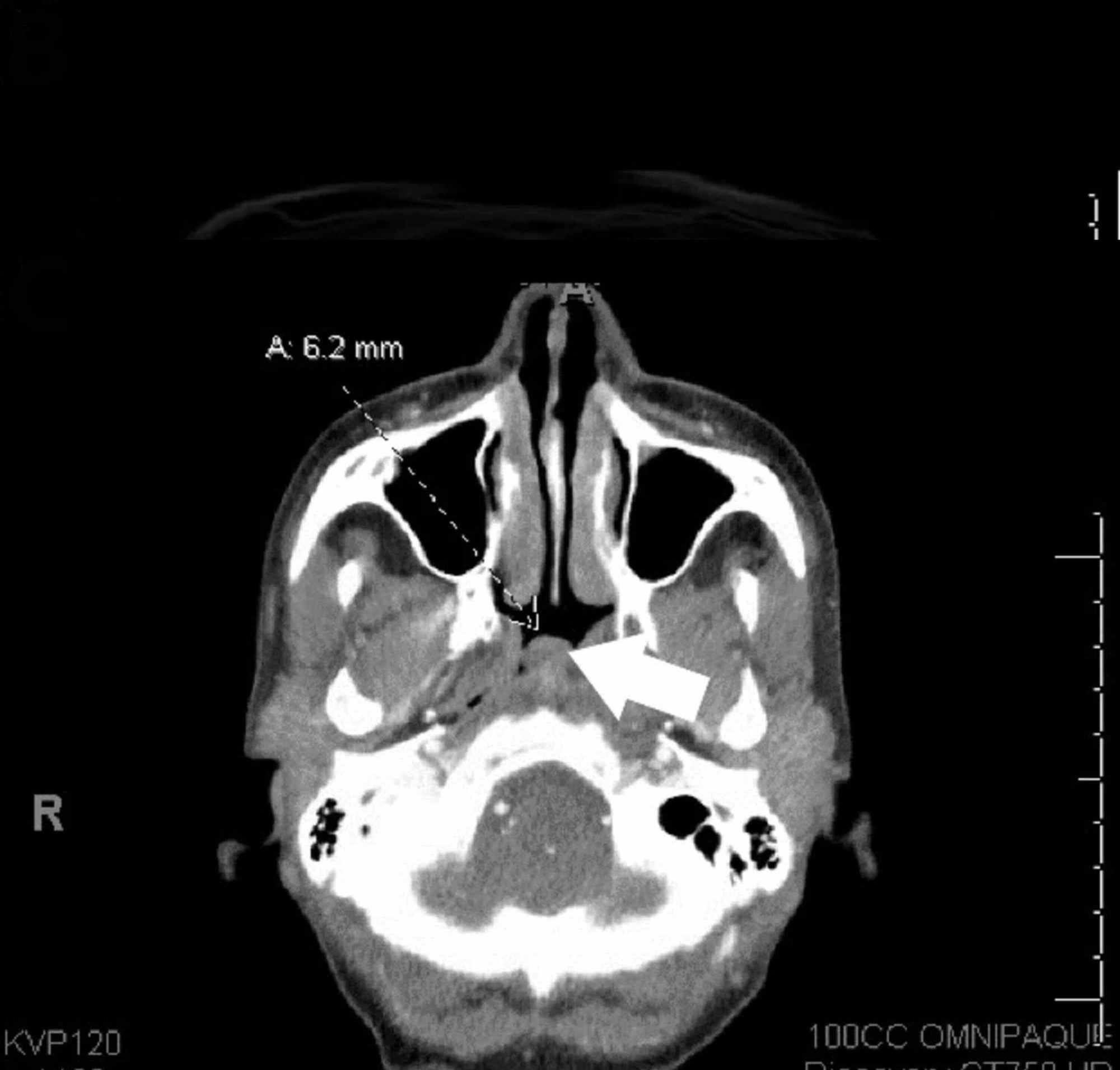 Cureus An Advanced Aids Patient With Cd4 And Plasmablastic Lymphoma Achieving Complete Response With The V Epoch Regimen