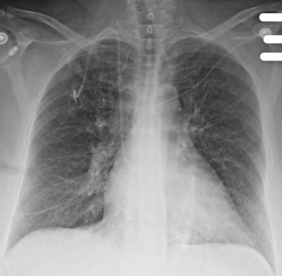 Cureus | A Case of Acute Heart Failure Following Immunotherapy for