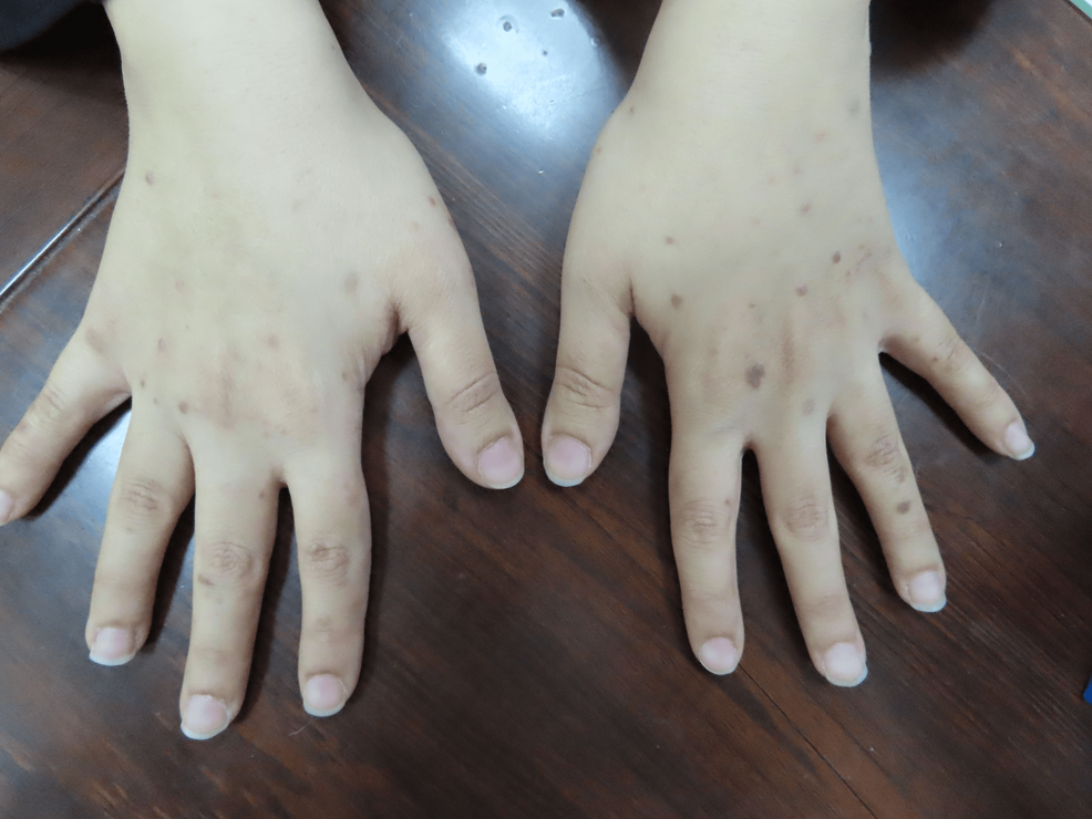 Eruptive-lesions-of-lichen-planus-on-the-upper-extremities Eruptive-lesions-of-lichen-planus-on-the-upper-extremities