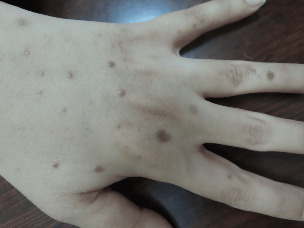 Multiple-lesions-of-lichen-planus-on-the-dorsum-of-the-left-hand Multiple-lesions-of-lichen-planus-on-the-dorsum-of-the-left-hand