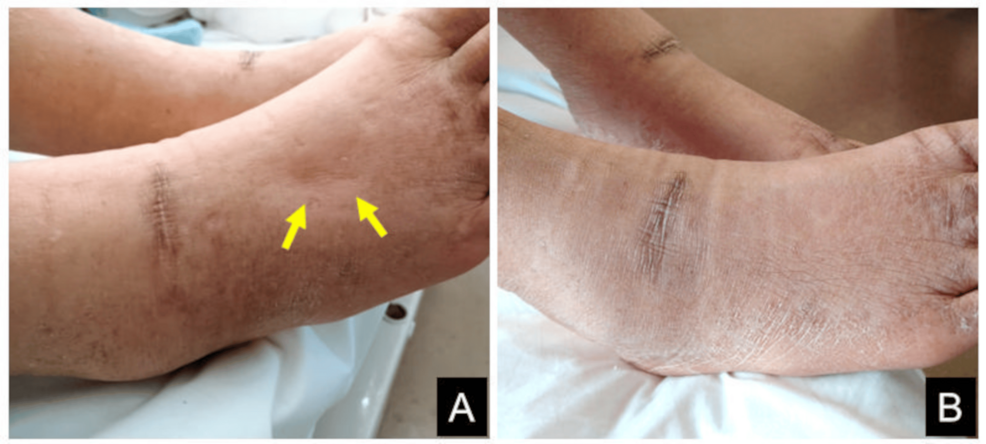 A Case Report of Wet Beriberi Due to Excessive White Rice Consumption ...