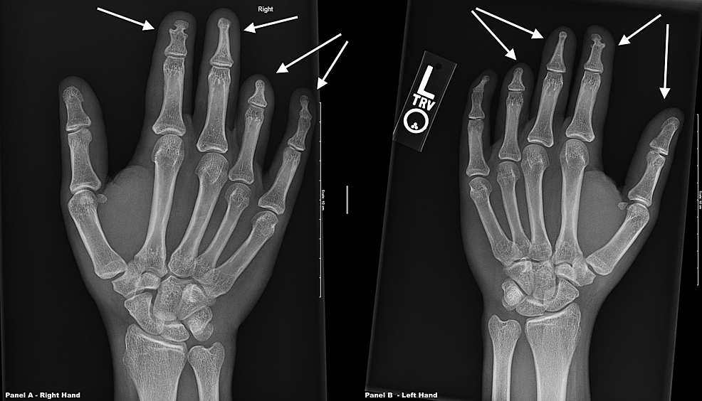 Cureus Hypertension With Brachydactyly Syndrome A Case Report