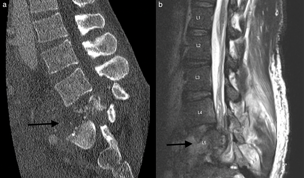 L5 Fracture Dislocation Secondary to Cold Abscess Treated by Posterior ...