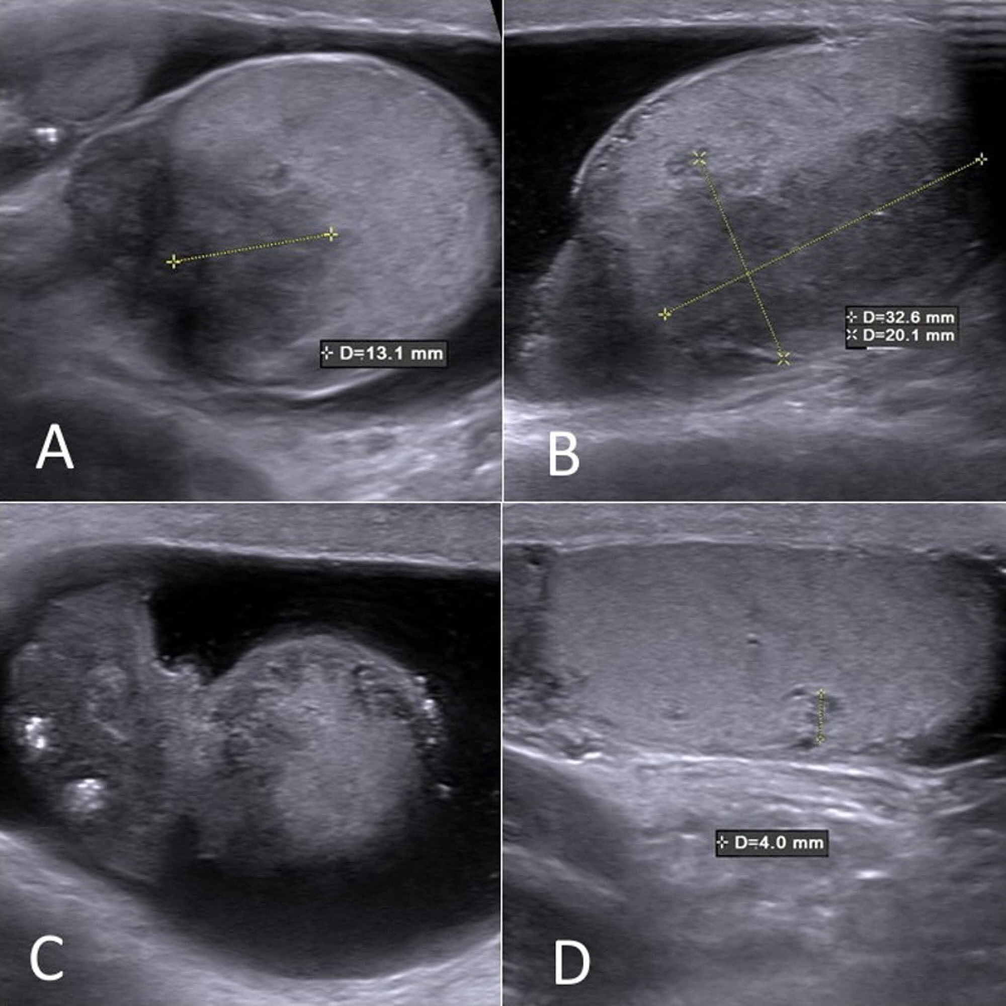 Cureus Testicular Sarcoidosis Diagnostic Approach And Management Strategies 9031