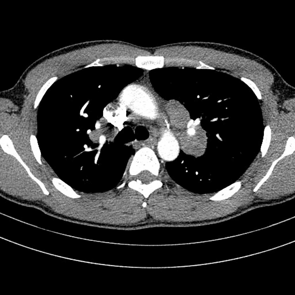 Testicular Sarcoidosis Diagnostic Approach And Management Strategies Cureus 5166