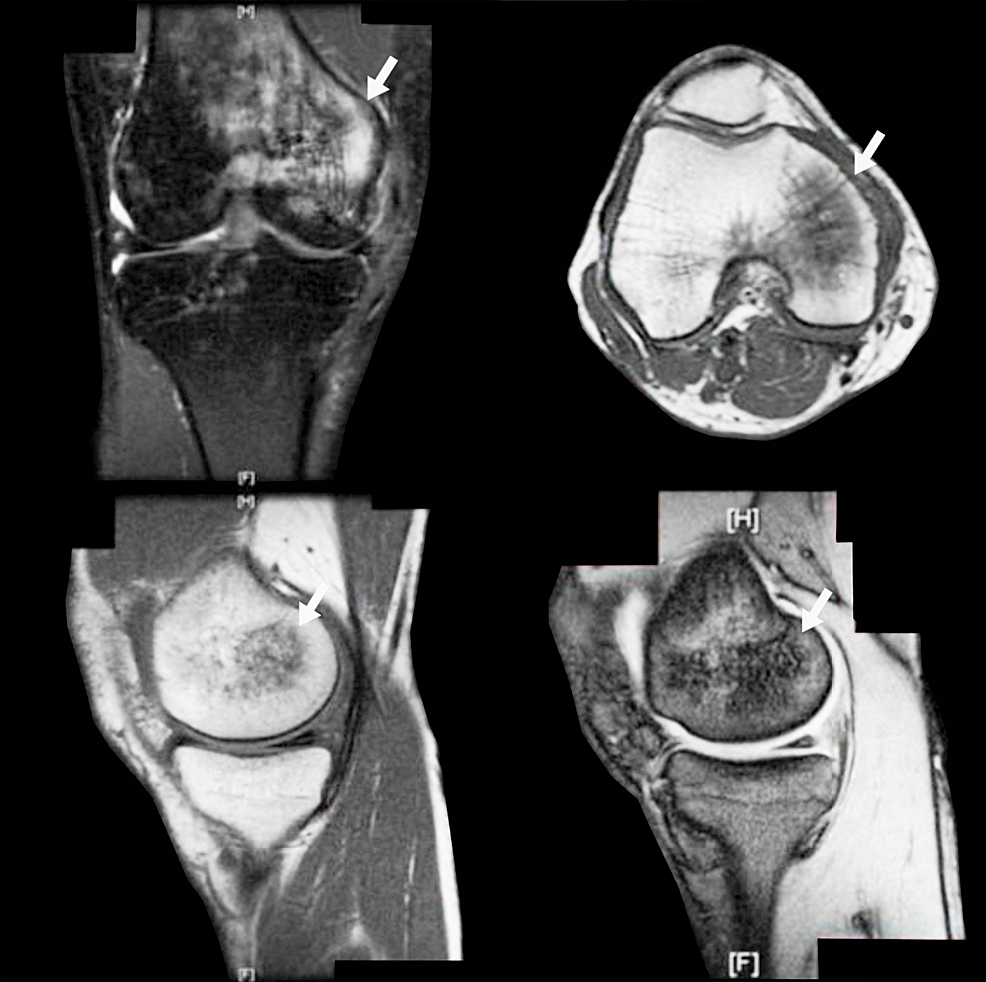 Cureus | Short-Term Teriparatide for Bone Marrow Edema Secondary to ...