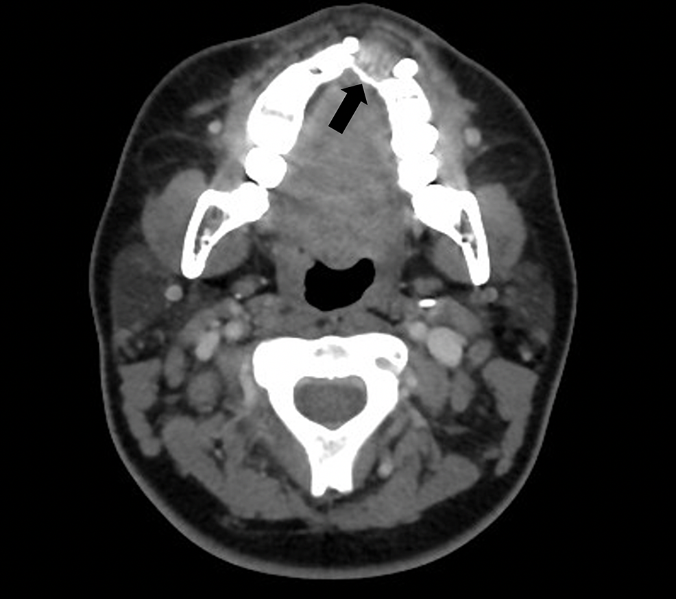 Cureus Diagnostic Challenges in Chondroblastic Maxillary A Case Report