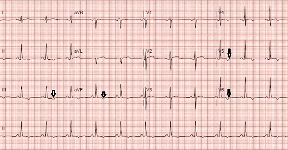 EKG--before-starting-hydroxychloroquine-and-azithromycin-showing-sinus-rhythm-at-75-beats/minute,-mild-t-wave-inversion-in-inferior-and-lateral-leads,-normal-QTc-interval