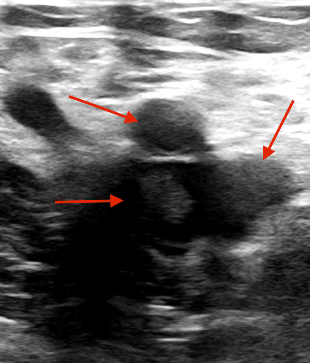 B12 Deficiency-Induced Hemolytic Anemia With an Extensive Deep Vein Thrombosis