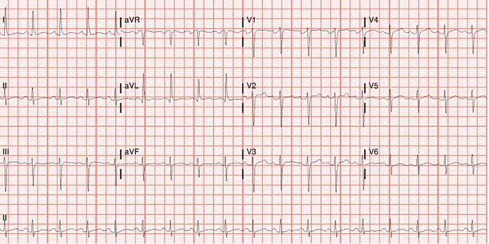 EKG-after-starting-hydroxychloroquine-and-azithromycin-showing-sinus-rhythm-at-100-beats/minute-and-normal-QTc-interval