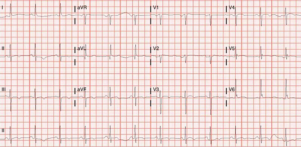 EKG-on-the-final-day-of-hydroxychloroquine-and-azithromycin-showing-normal-sinus-rhythm-at-75-beats-per-minute,-non-specific-t-wave-abnormality-and-normal-QTc-interval