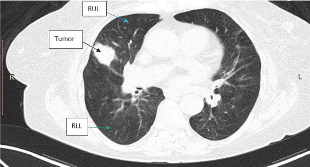 Lymphoepithelial Carcinoma of the Lung: A Case Report and Review