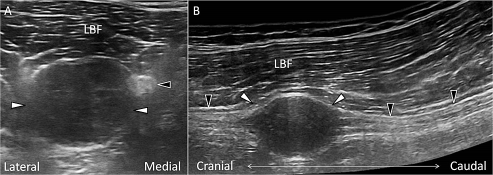 Cureus | Ultrasound Imaging for a Rare Cause of Sciatica ...