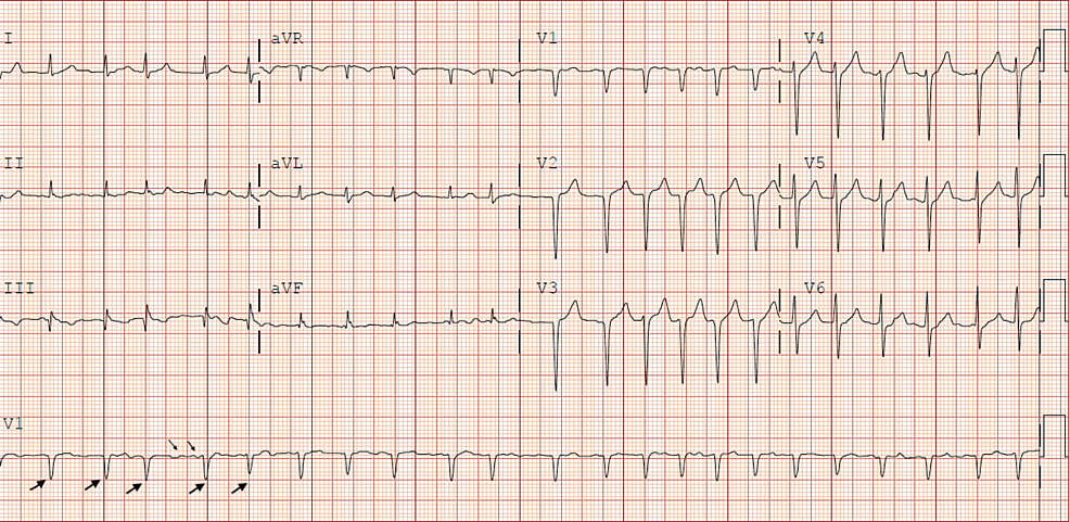 Cureus | Coronavirus Disease and New-Onset Atrial Fibrillation: Two Cases