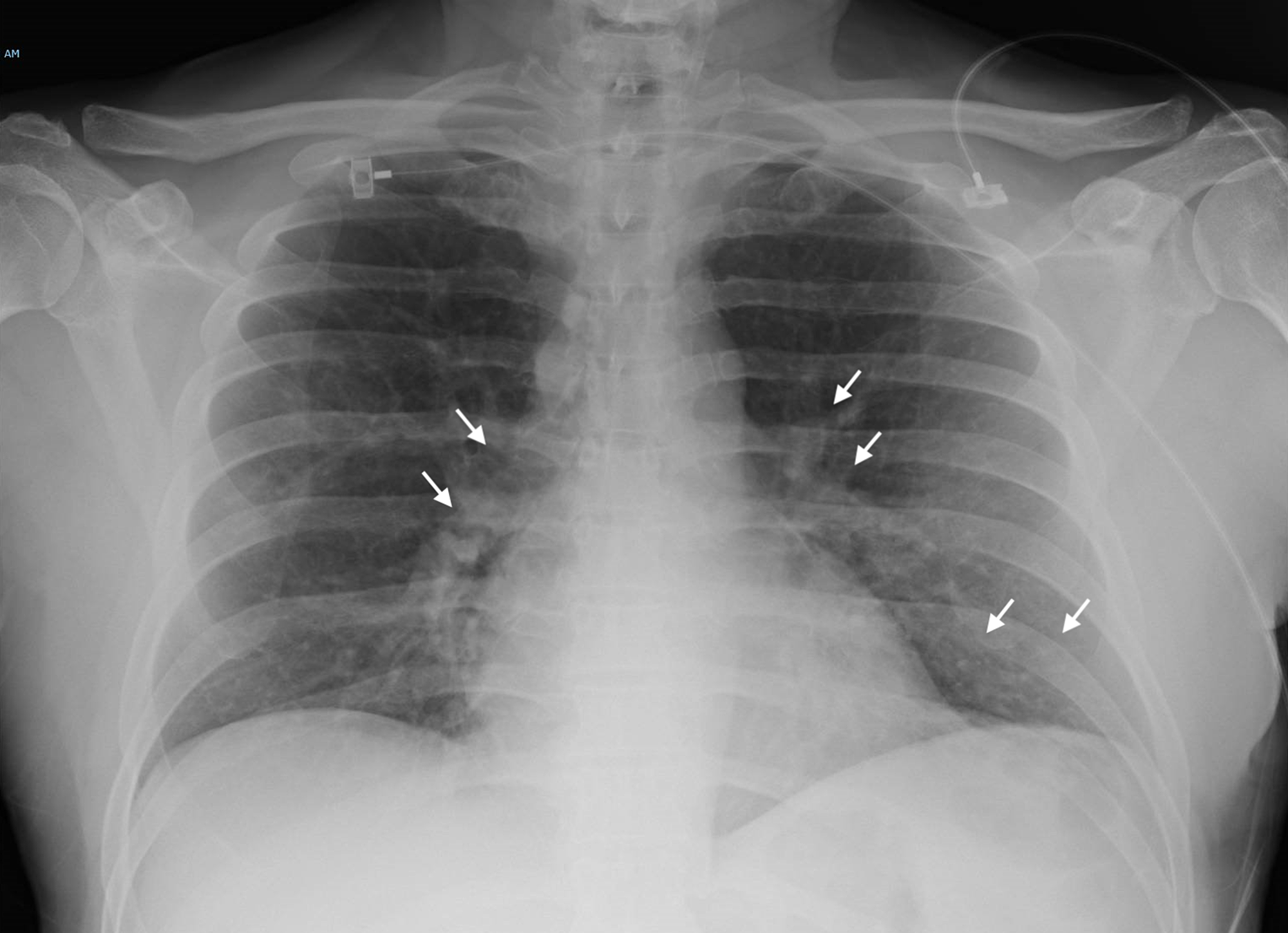 Cureus | Coronavirus Disease and New-Onset Atrial Fibrillation: Two Cases