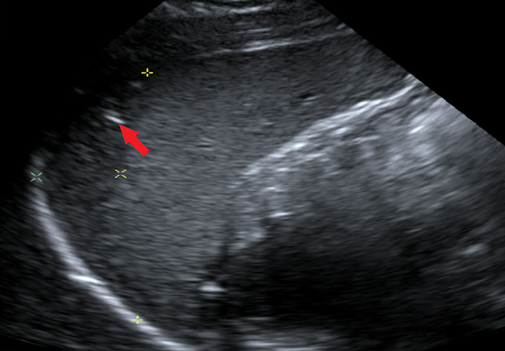 Complete-abdominal-ultrasound-(US):-Crescentic-hypoechoic-material-around-the-edge-of-the-spleen,-underlying-the-dome-of-the-left-hemidiaphragm.