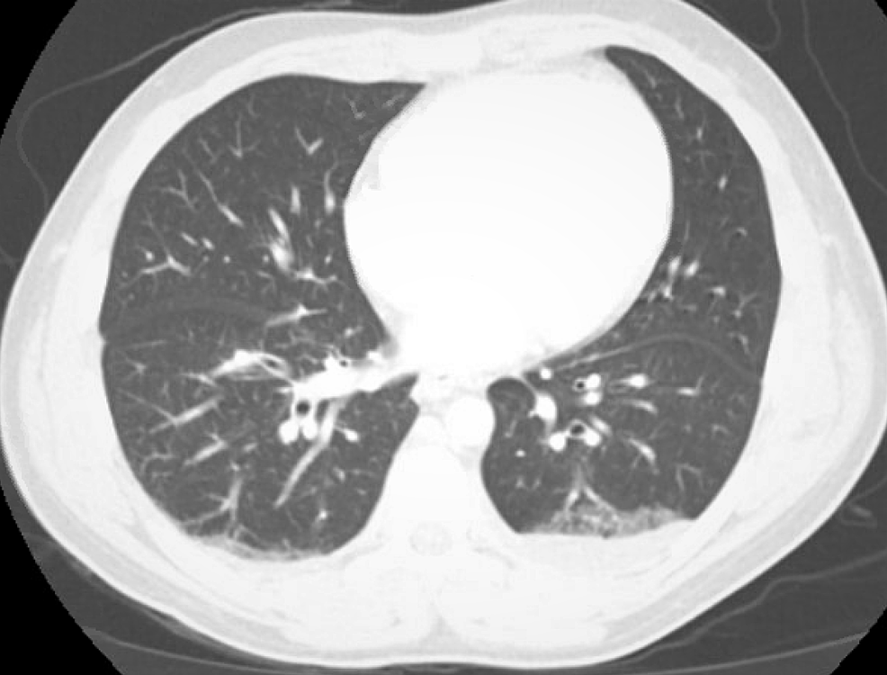 A Rare Case of the Newly Recognized Kaposi Sarcoma Herpesvirus ...