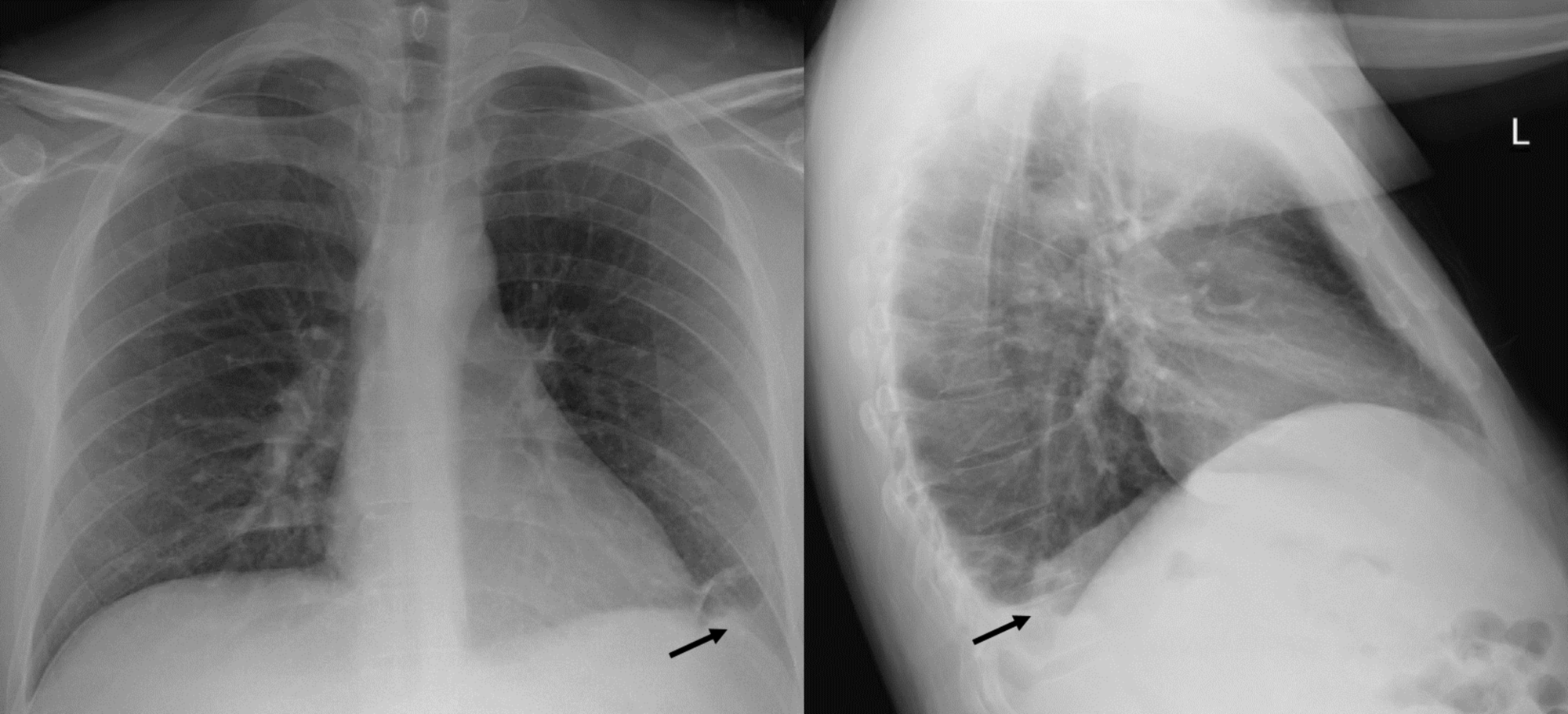Cureus A Rare Case of the Newly Recognized Kaposi Herpesvirus