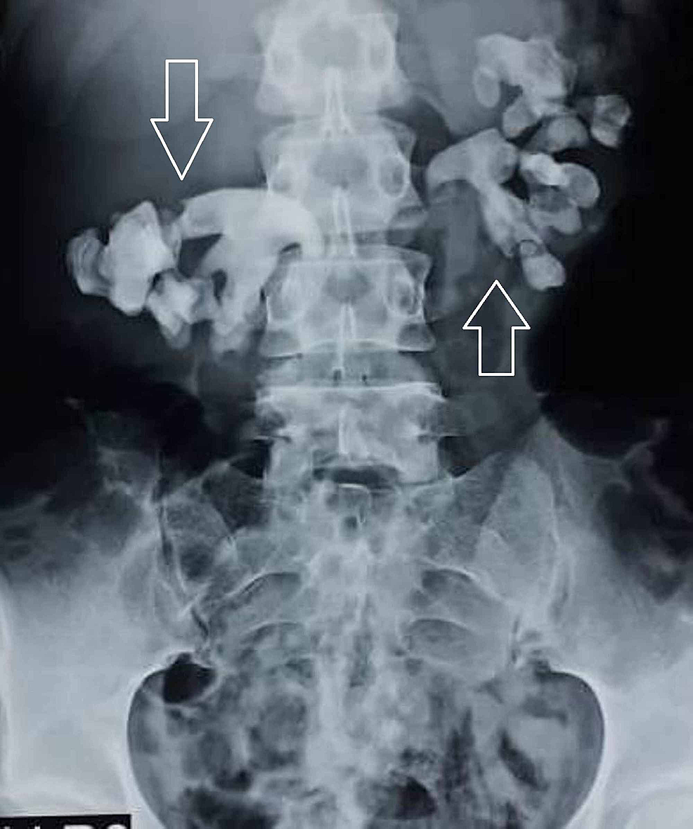 kidney stone staghorn calculus