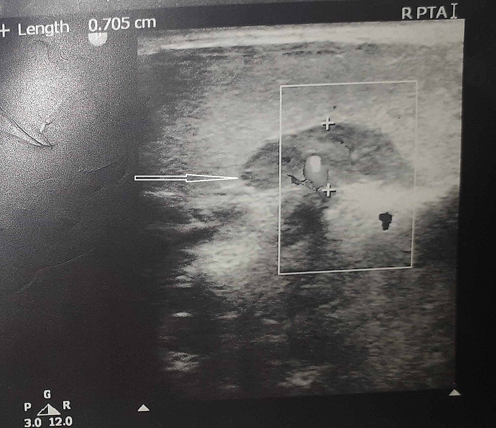 Cureus | Revisiting a Case of Parathyroid Adenoma With Bilateral ...