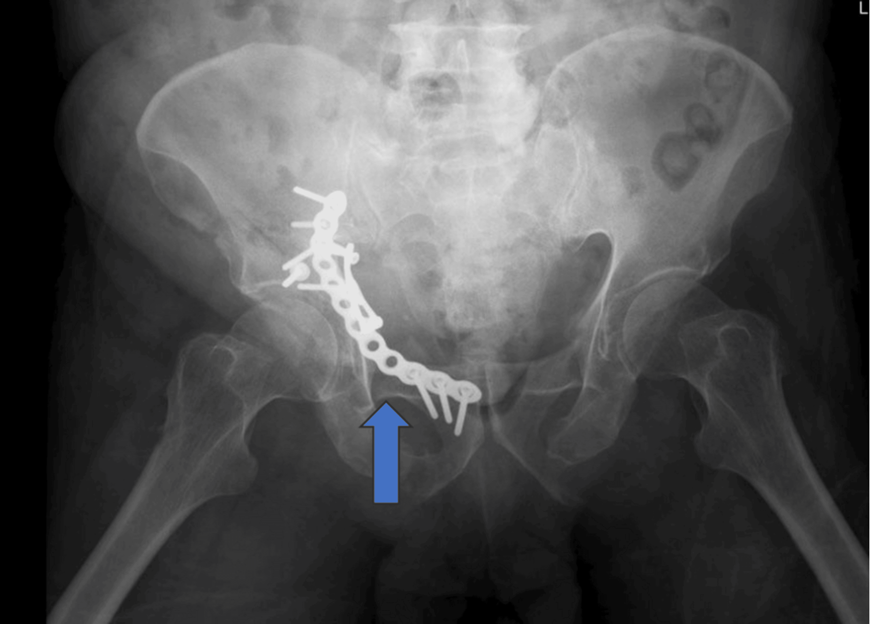 Successful Management of an Acetabular Fracture Associated With