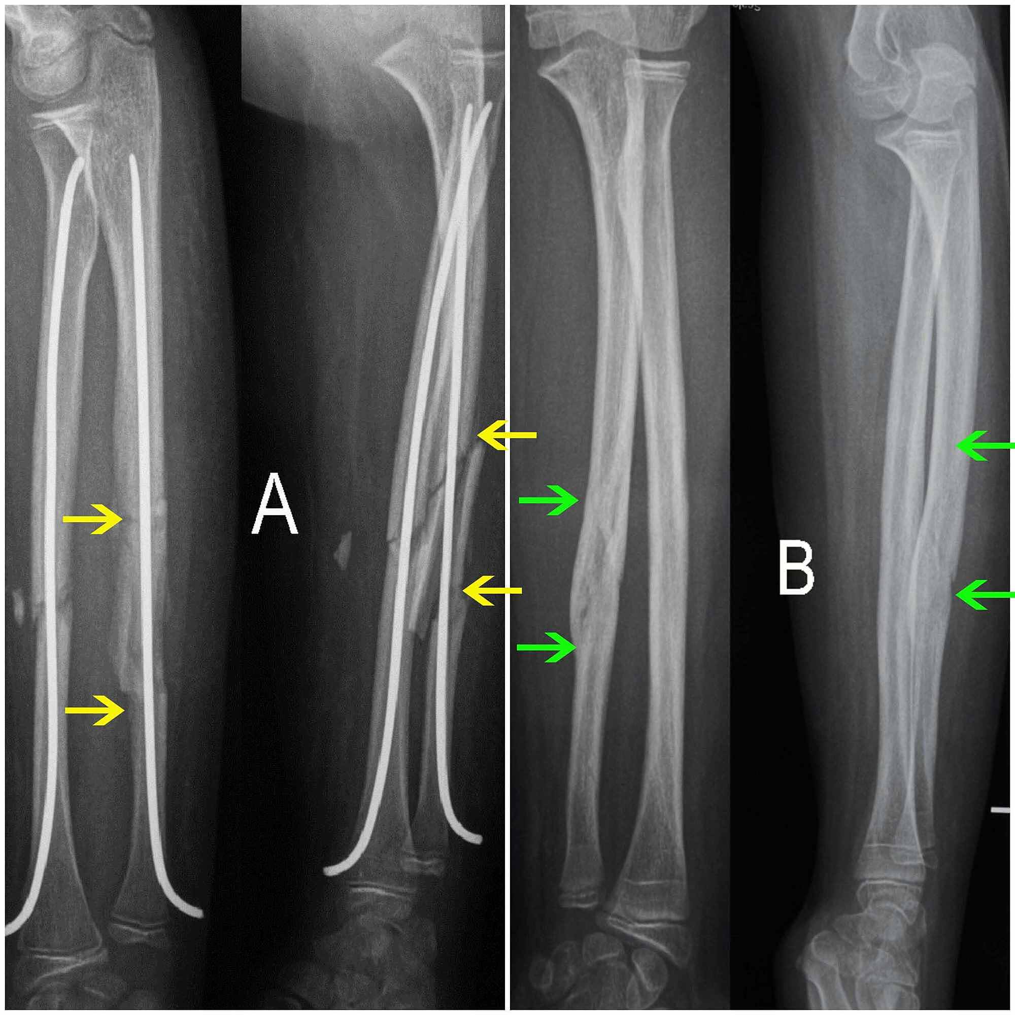 Cureus Retrograde Fixation Of The Ulna In Pediatric Forearm Fractures