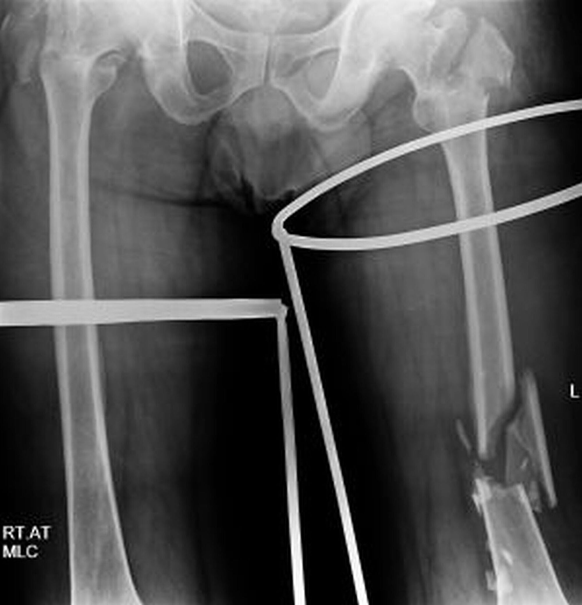 right femoral intertrochanteric fracture icd 10