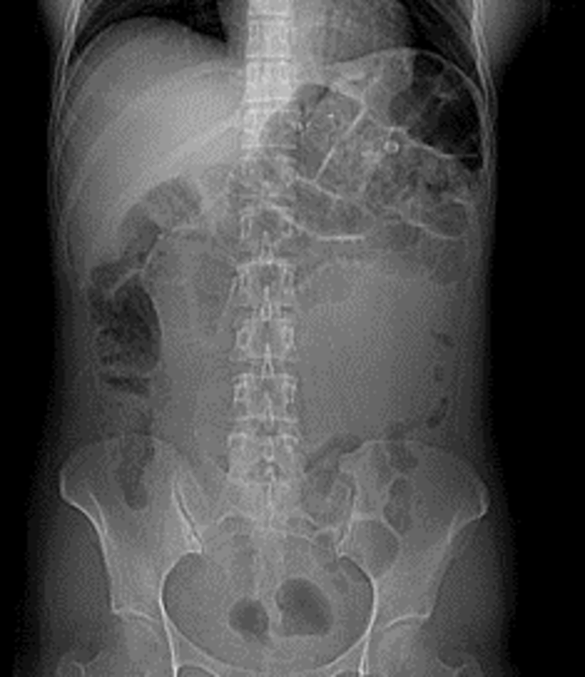 Cureus Retrograde Intussusception after RouxenY Gastric Bypass