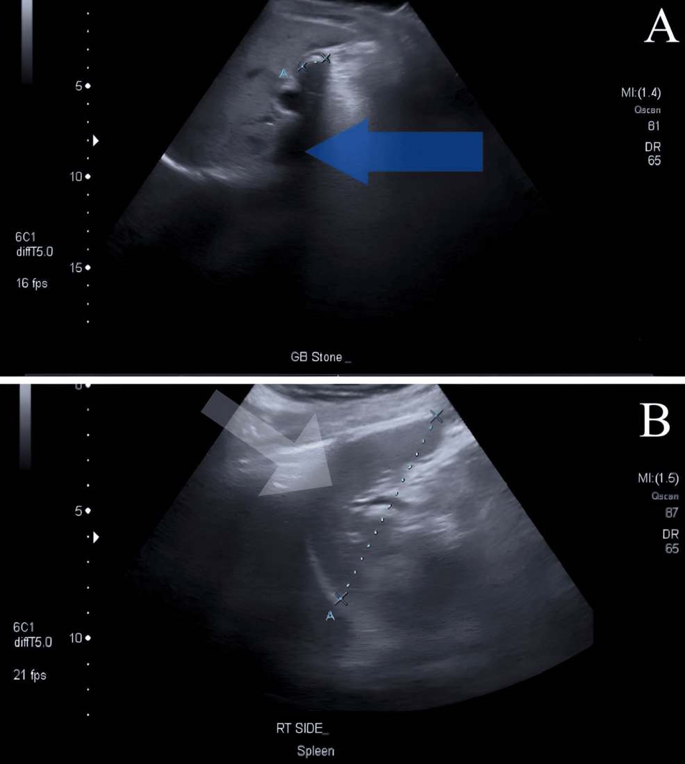 Gallstones in the mirror: A case report of successful laparoscopic treatment of cholelithiasis in situs inversus totalis