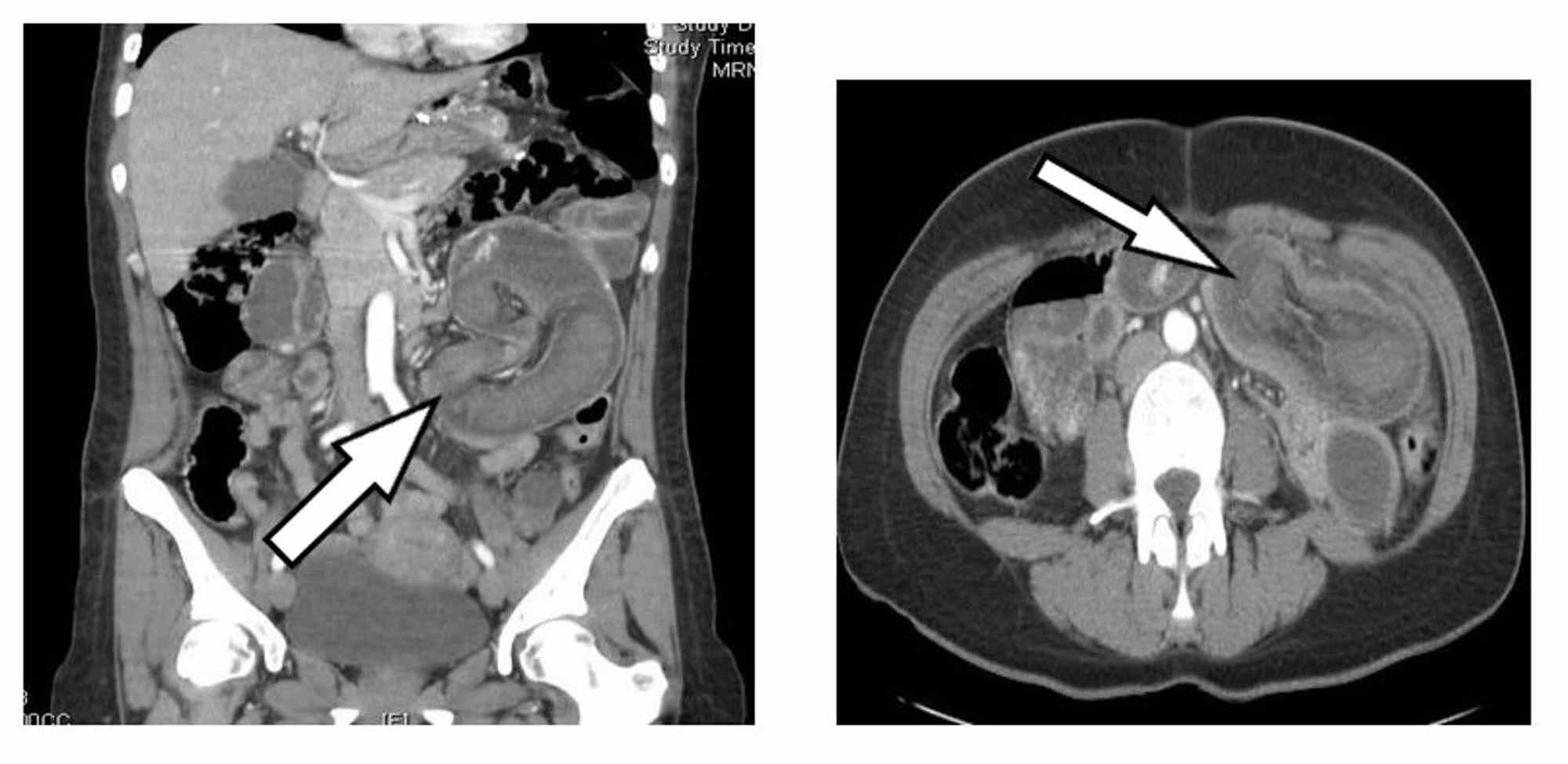 Cureus Retrograde Intussusception after RouxenY Gastric Bypass