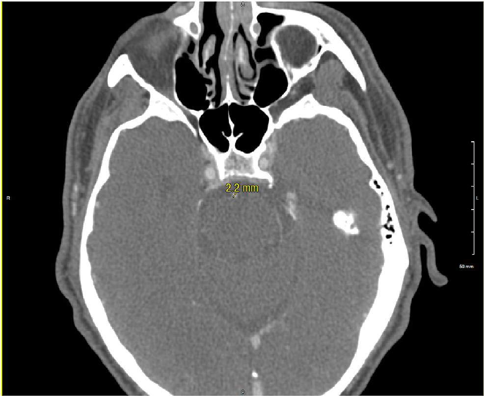 CT-angiography-(CTA)-head-performed-on-hospital-day-1-showing-a-small-caliber-basilar-artery-measuring-at-2.2-mm.