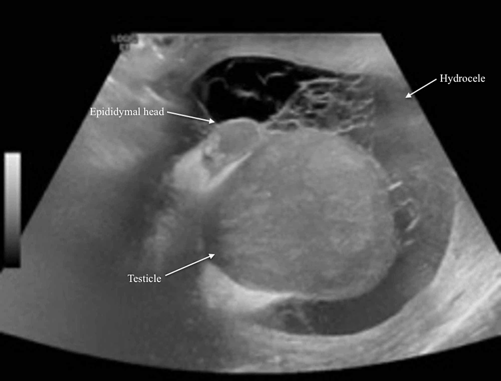 cureus-testicular-abscess-and-ischemia-secondary-to-epididymo-orchitis