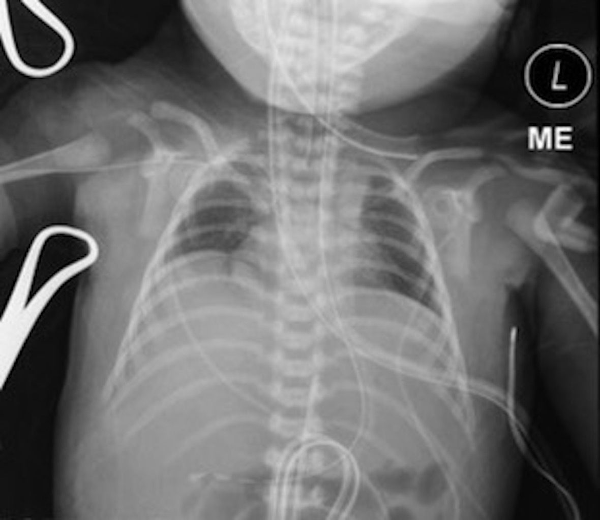 Cureus Infant With Clinical Evidence Of Pulmonary Hypoplasia A Case Report