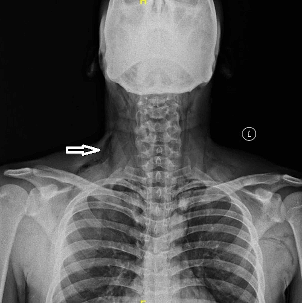 Cureus Spontaneous Pneumomediastinum in a Young Adult A Rare Presentation