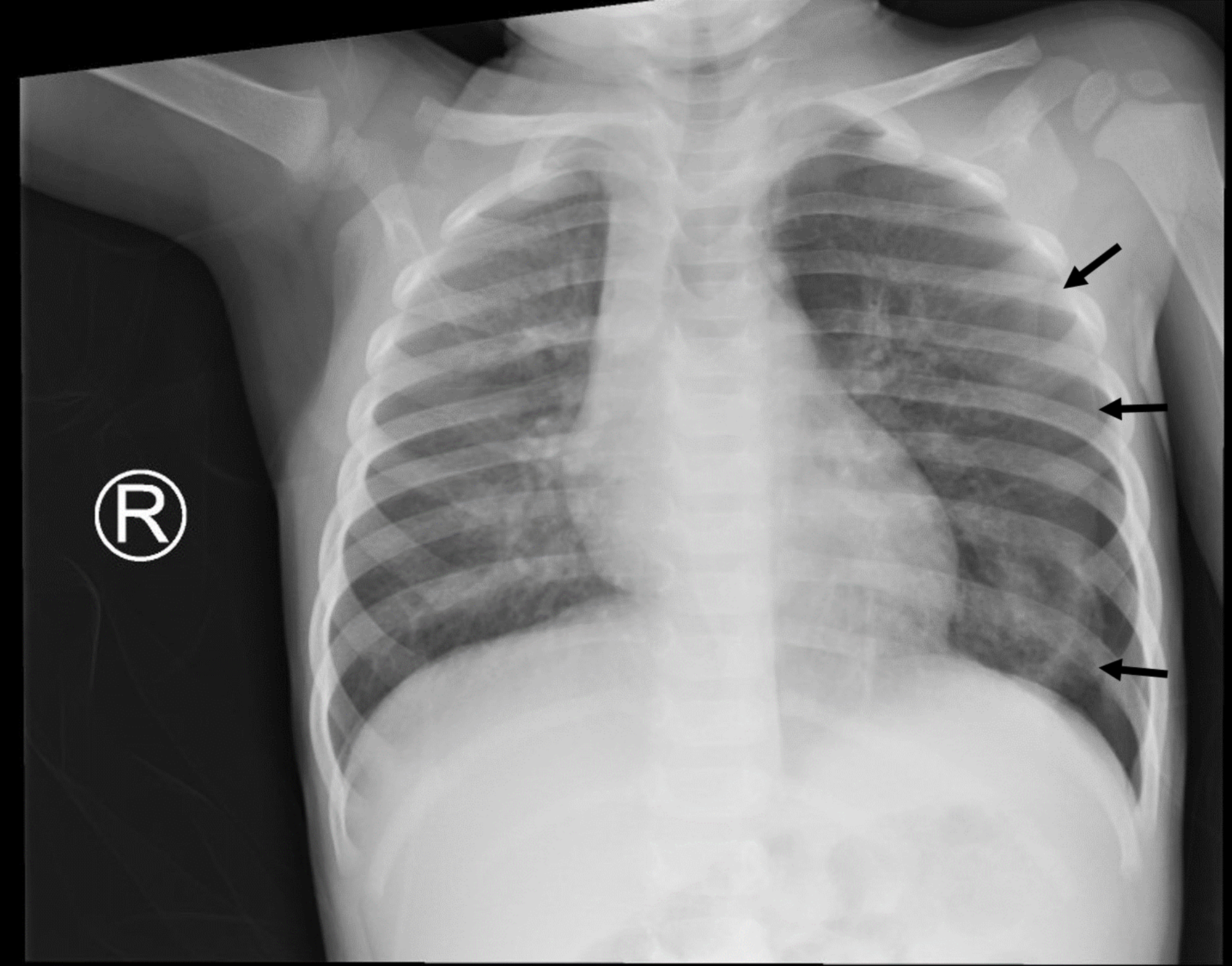 X Ray Images Of Pneumothorax