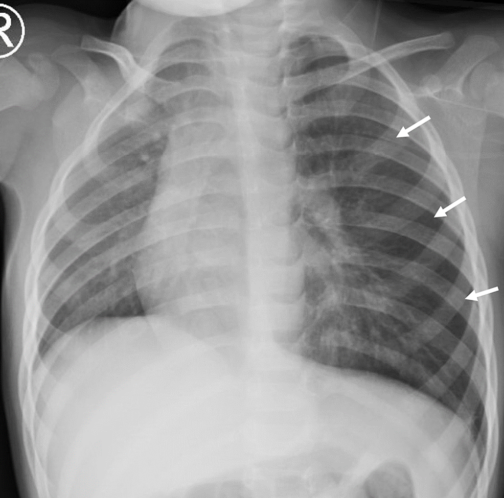 cureus-foreign-body-aspiration-presenting-as-pneumothorax-in-a-child