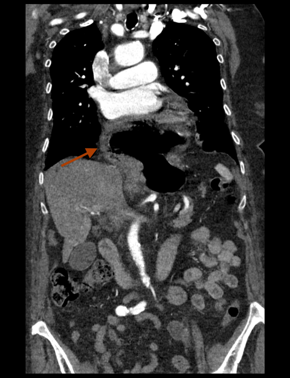 bpc 157 hiatal hernia Successful Hiatal Hernia Repair in a 95-Year-Old Patient: A Case Report