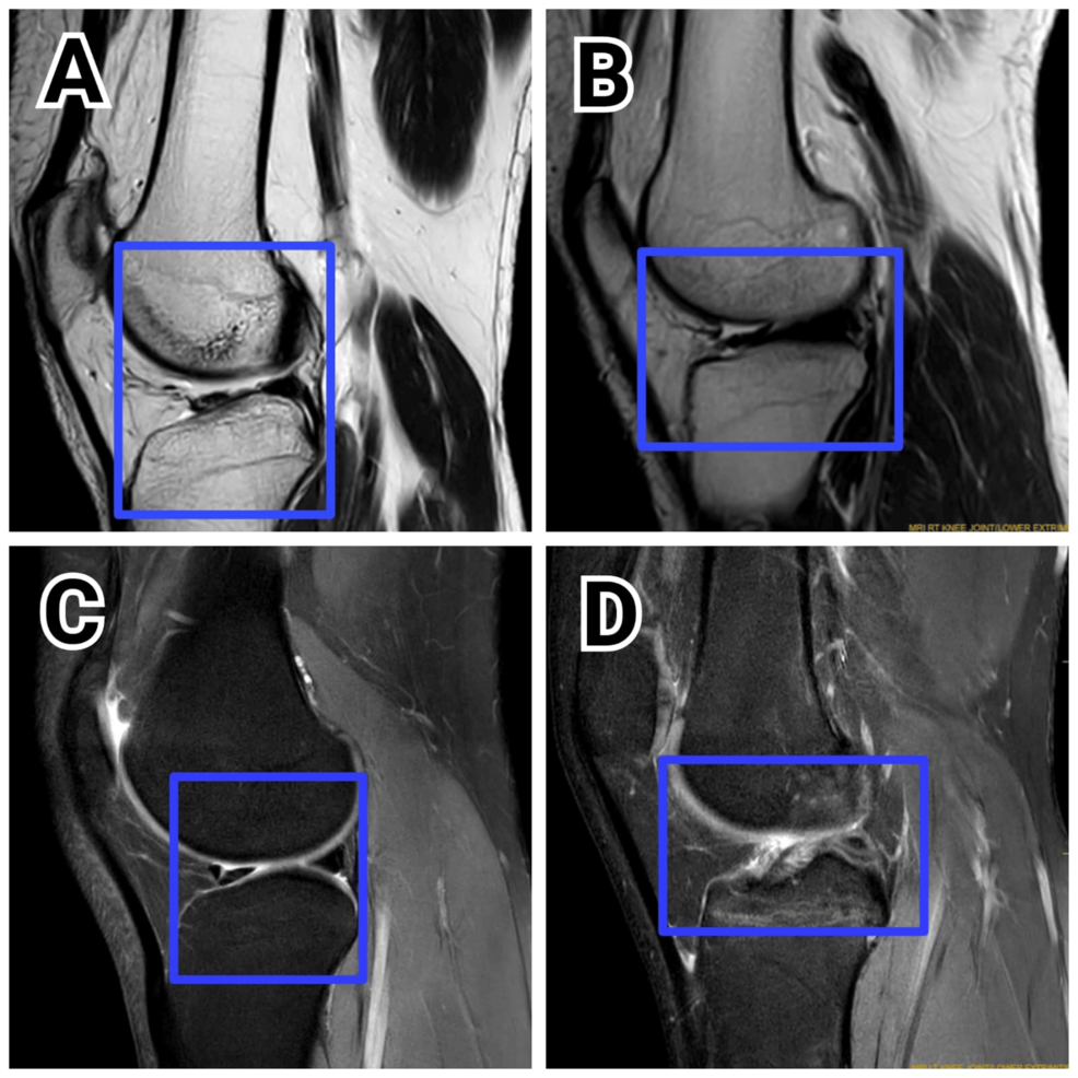 Restoring mobility and stability: A case series on various innovative rehabilitation strategies after anterior cruciate ligament reconstruction