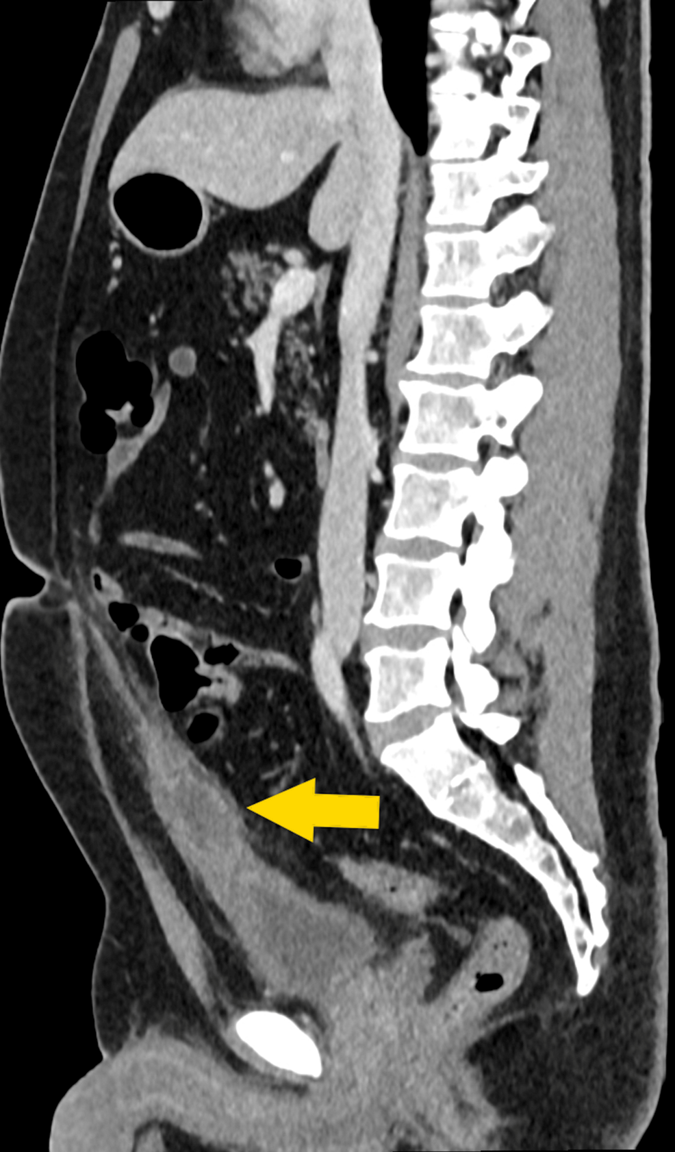 Unmasking A Rare Cause Of Acute Abdomen In Adults: A Case Report Of An 