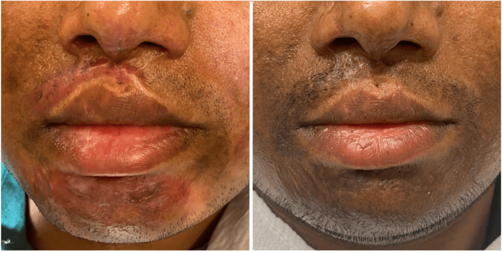 bpc 157 gets rid of scar tissue Platelet-Rich Plasma Plus Microneedling for Management: Introduction to an Innovative Technique and Initial Results From 107 Patients LVLUP Health In Phoenix