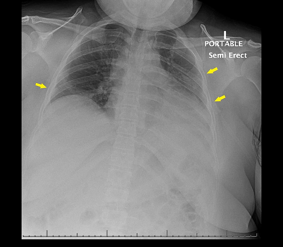 Initial-chest-radiograph-with-patchy-opacities-in-the-left-mid-to-lower-lung-and-right-lung-base-suspicious-for-a-multi-focal-infectious-process-(arrows)