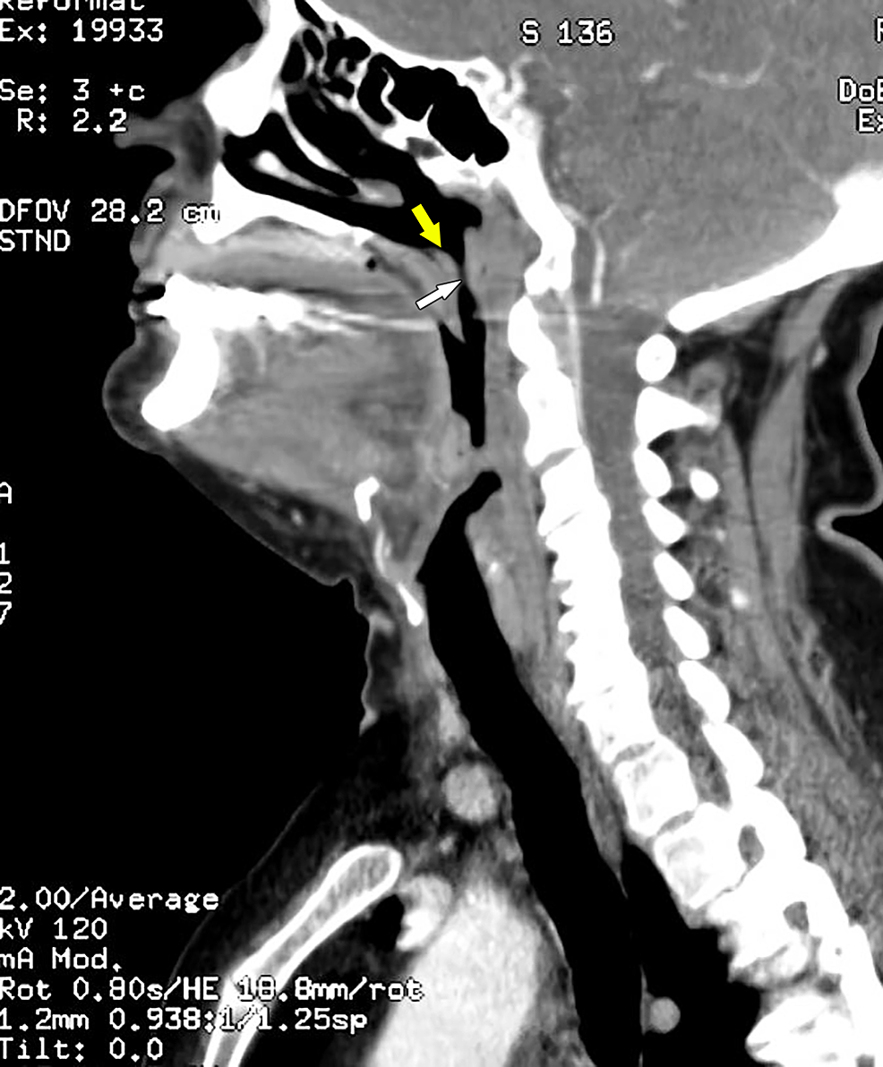 Cureus | An Uncommon Case of Partial Airway Obstruction due to Lingual ...