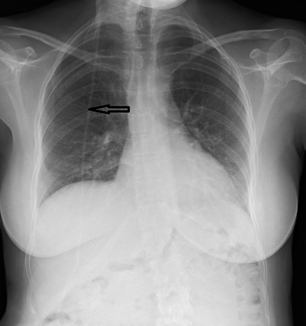 Ventriculoperitoneal ShuntAssociated Ascites A Case Report Cureus