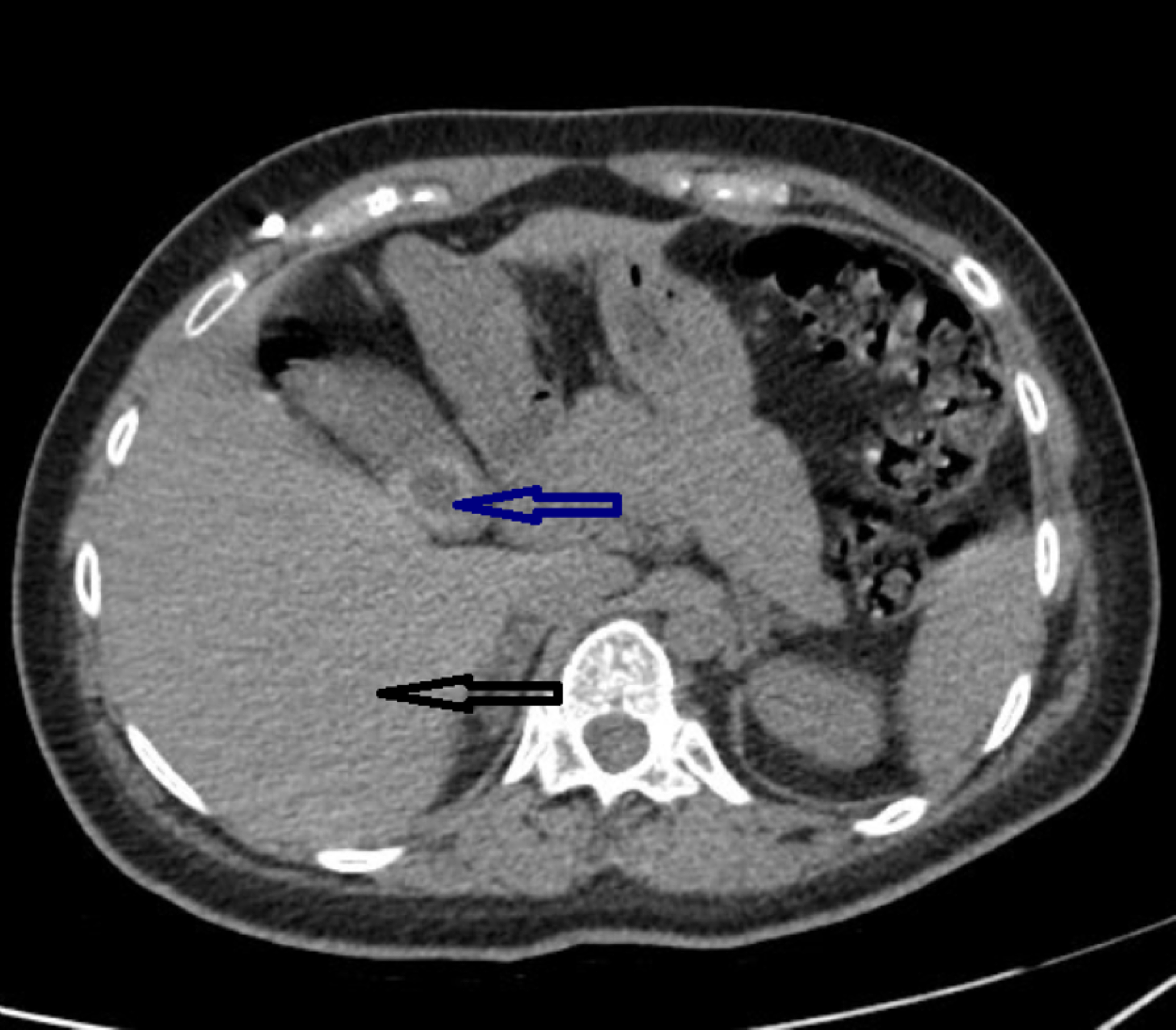 Cureus | Ventriculoperitoneal Shunt-Associated Ascites: A Case Report