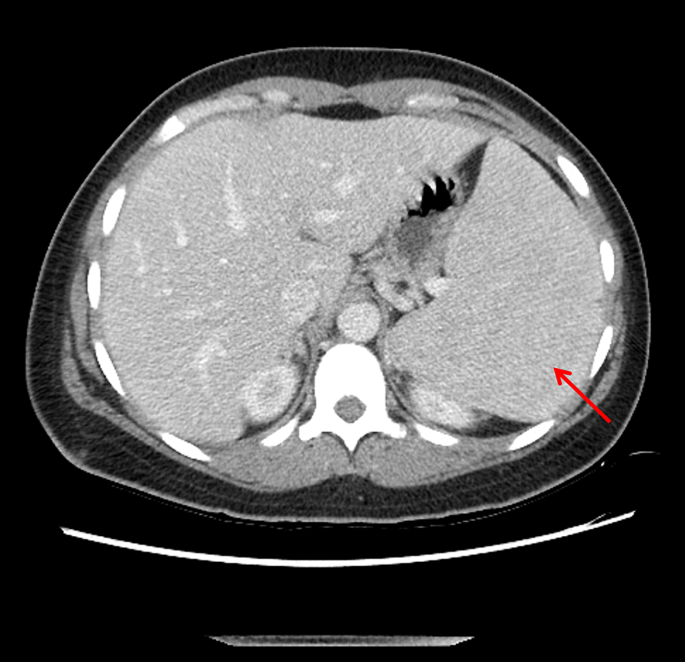 cureus-acute-splenic-sequestration-crisis-in-hemoglobin-sc-disease