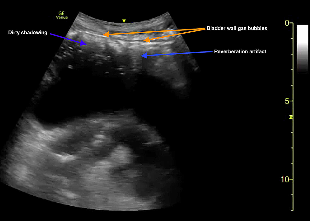 Point-of-care-ultrasound-demonstrating-an-air-fluid-level-of-the-bladder.-Gas-bubble-of-anterior-bladder-wall-is-indicated-by-multiple-hyperechoic-foci-(orange-arrows)-with-corresponding-reverberation-artifact-and-dirty-shadowing-(blue-arrows).