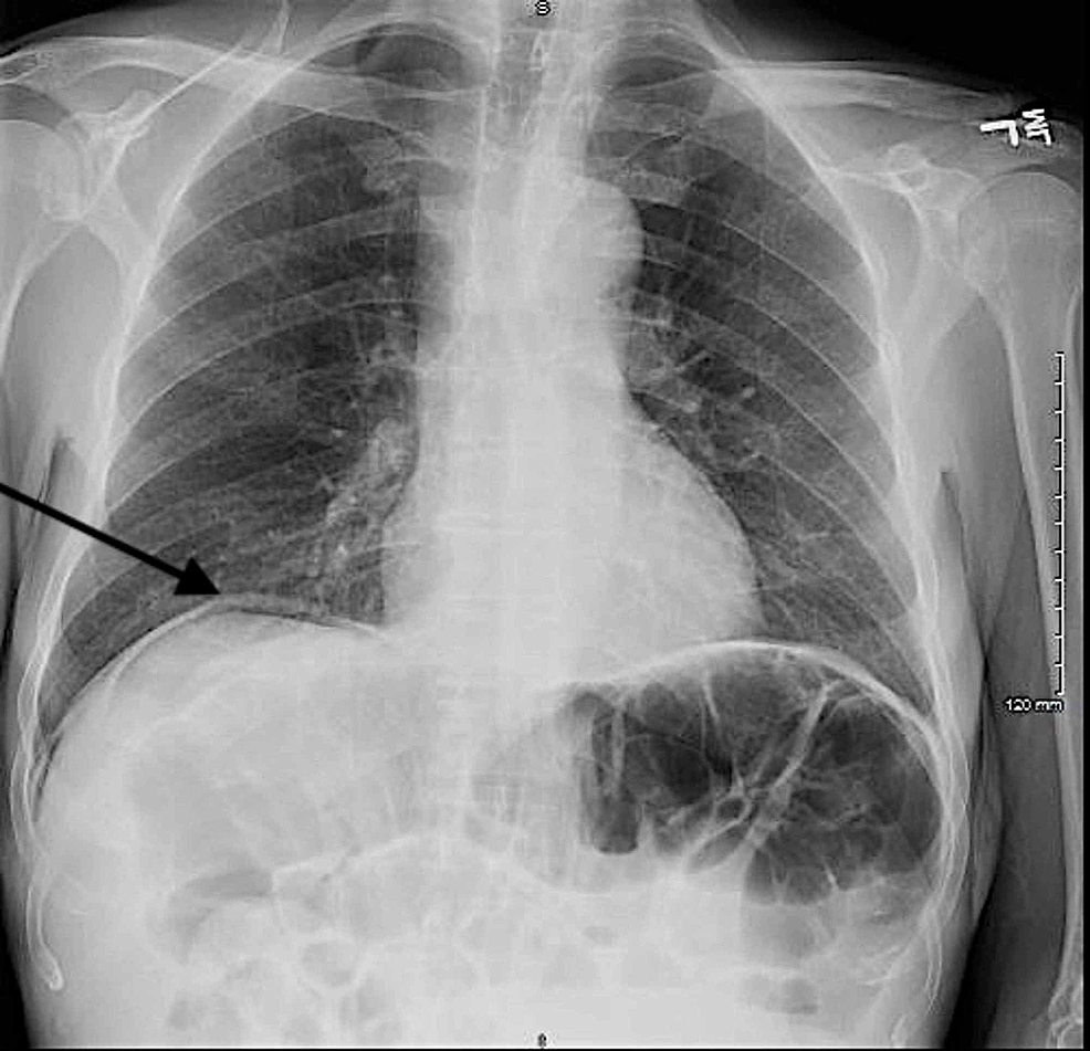 Portable-chest-radiography-demonstrating-free-air-under-the-diaphragm-on-the-right-(black-arrow)-consistent-with-bowel-perforation.