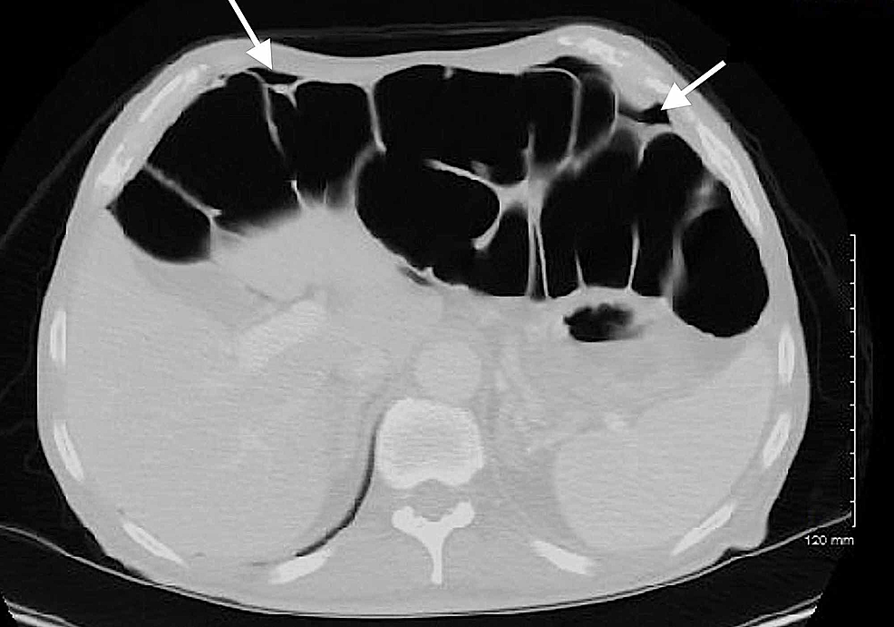 CT-of-the-abdomen/pelvis-demonstrating-intraperitoneal-free-air-(white-arrows).
