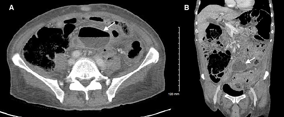 CT-of-the-abdomen/pelvis-demonstrating-an-intra-abdominal-abscess-collection-#1-(white-arrows)-secondary-to-sigmoid-colon-perforation.-Axial-(A)-and-coronal-(B)-planes.